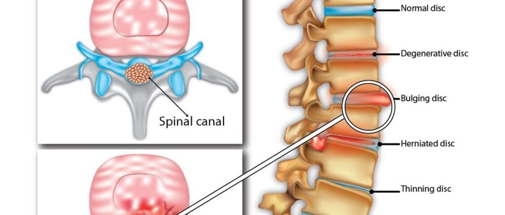 Slipped Disk Rash Slipped Disc Explained: Causes, Symptoms, and Treatment Options ...