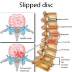 slipped disc