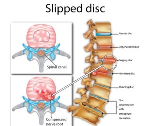 slipped disc