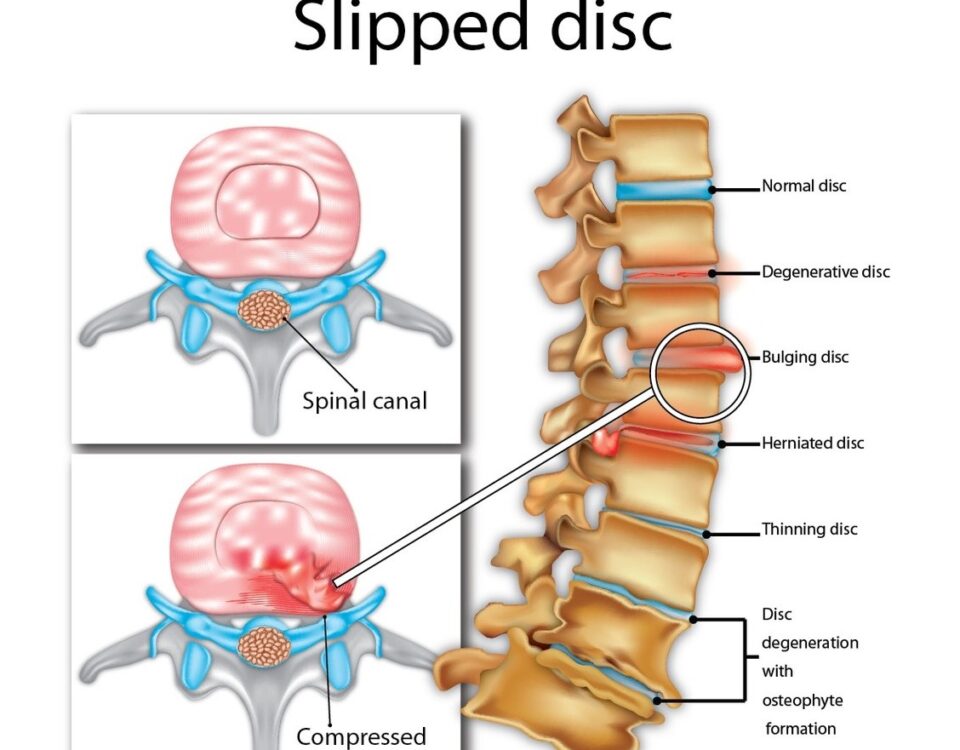 slipped disc